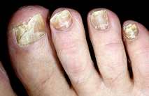 fungal-nail-2