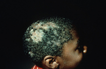 ringworm-scalp-2