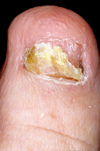 fungal-nail-2